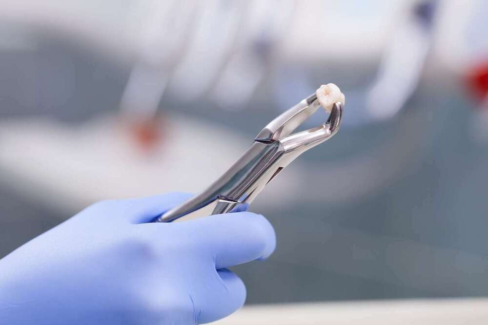 Les extractions dentaires