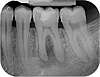 radiographie des dents