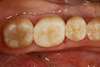Molaire cariée après onlay