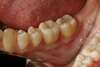 Dent après pose onlay