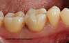 Molaire après onlay