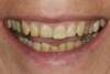 Dents avant facettes