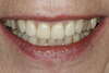 Dents après facettes