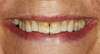Dents avant pose facettes
