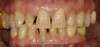 Dent avant traitement facettes