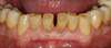 Dents sans facettes