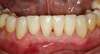 Dents avec facettes