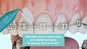 Nettoyage des brackets avec brossette interdentaire