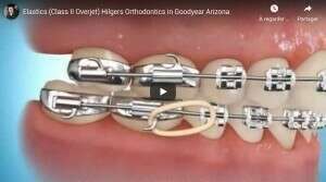 Correction avec élastique classe 2.