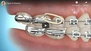 Correction avec élastique classe 3.