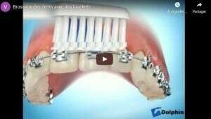 Brossage des dents avec des brackets