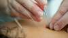 acupuncture