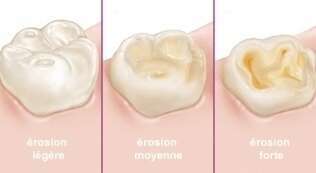 L’érosion dentaire
