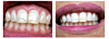 Blanchiment des dents avant et après