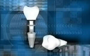 Pose d'un implant dentaire sans lambeau (technique "flapless")