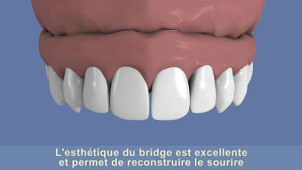 Maxillaire complet et traitement implantaire pour un bridge fixe scellé