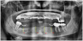 CAS DE RÉHABILITATION GLOBALE MAXILLAIRE ET MANDIBULAIRE