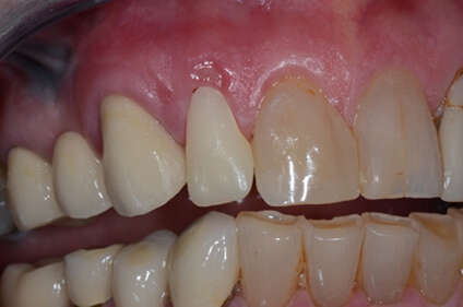 RÉHABILITATION ESTHÉTIQUE EN URGENCE D'UNE INCISIVE LATÉRALE RÉALISÉE EN TOUT CÉRAMIQUE