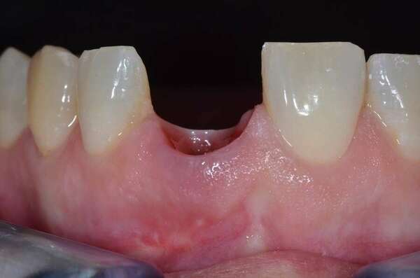 CAS ESTHÉTIQUE ANTÉRIEUR D'UNE INCISIVE CENTRALE MAXILLAIRE