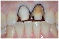 CAS ESTHÉTIQUE ANTÉRIEUR POUR 2 INCISIVES CENTRALES