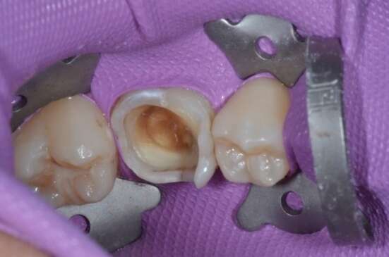 REMPLACEMENT D'UN AMALGAME CARIE PAR UN ONLAY CERAMIQUE E-MAX, CAS DU DR MAXIME COLLANGETTES