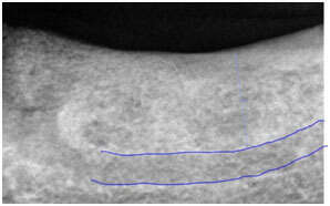 EVITER UNE GREFFE OSSEUSE LOURDE PAR DES IMPLANTS DE PETITE TAILLE