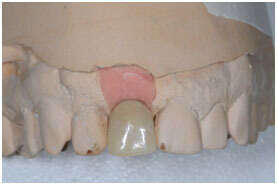 REMPLACEMENT D'UNE INCISIVE CENTRALE MAXILLAIRE