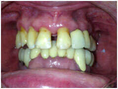 MISE EN CHARGE IMMEDIATE SUR 6 IMPLANTS STRAUMANN