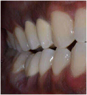 ESTHETIQUE ET PROTHÈSE TOUT CÉRAMIQUE