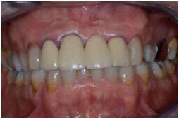 ESTHÉTIQUE ET IMPLANTOLOGIE IMMÉDIATE