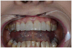 ESTHÉTIQUE ANTÉRIEURE ET COURONNES CÉRAMO CÉRAMIQUES