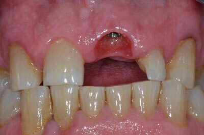 MISE EN CHARGE IMMÉDIATE D'UNE INCISIVE CENTRALE MAXILLAIRE