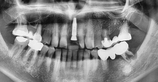 MISE EN CHARGE IMMÉDIATE D'UNE INCISIVE CENTRALE MAXILLAIRE
