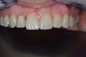 ESTHÉTIQUE, MISE EN CHARGE IMMÉDIATE ET IMPLANT DE PETIT DIAMÈTRE POUR REMPLACER UNE AGÉNÉSIE D INCISIVE LATÉRALE MAXILLAIRE, CHIRURGIE GUIDÉE