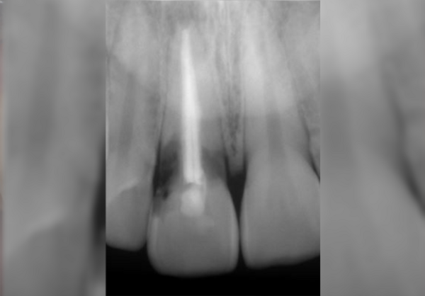 MISE EN CHARGE IMMEDIATE D'UNE INCISIVES CENTRALE MAXILLAIRE AVEC RESORPTION INTERNE
