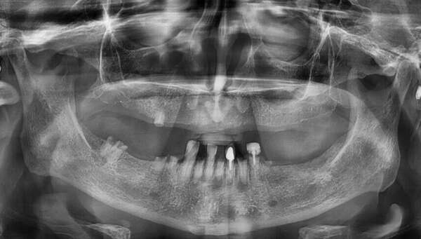 CAS DE DOUBLE MISE EN CHARGE IMMÉDIATE