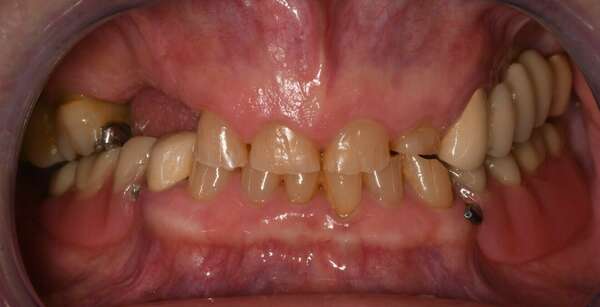 Réhabilitation Globale dans le cadre d'une usure dentaire sévère