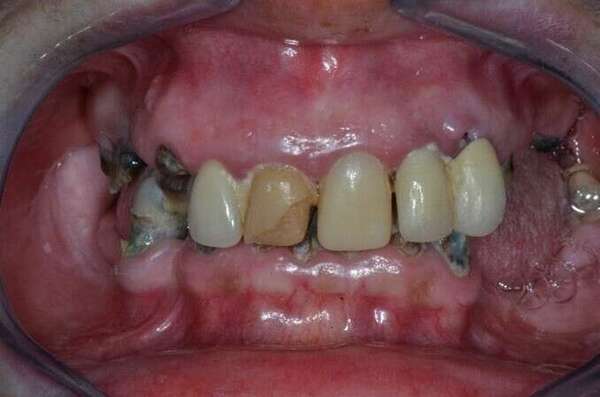 MISE EN CHARGE IMMÉDIATE MAXILLAIRE ET MANDIBULAIRE