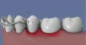 Traitement ultrasonique de la parodontite