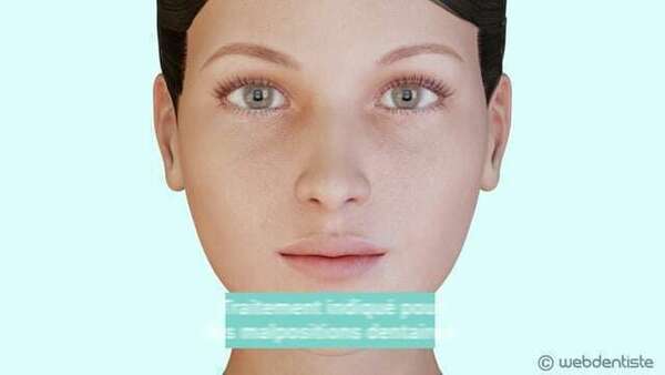 Appareil multi-attache en céramique