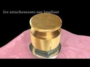 Attachement unitaire