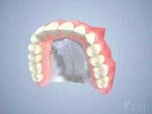 Prothèse dentaire complète amovible (dentier)