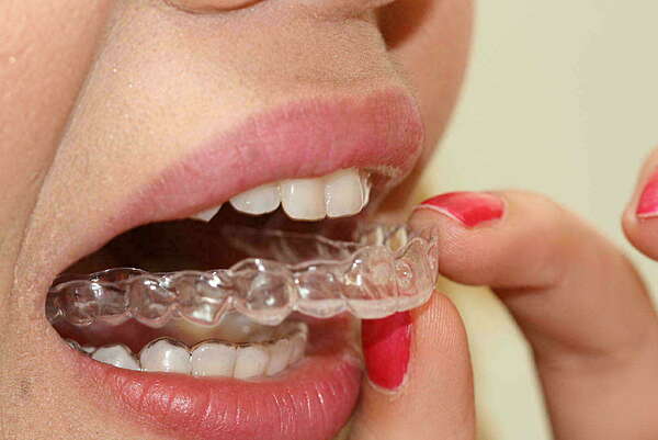ORTHODONTIE DE L'ADULTE : TECHNIQUE PAR ALIGNEURS (GOUTTIÈRES TRANSPARENTES)