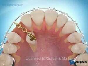 Exposition palatine avec traction chirurgicale