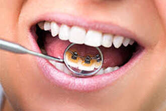 L’ORTHODONTIE LINGUALE