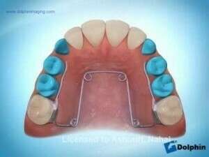 action du quad-hélix sur un encombrement dentaire