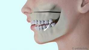 La chirurgie orthognatique – correction de béance antérieure