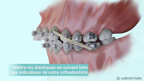 Les élastiques de classes ii et iii