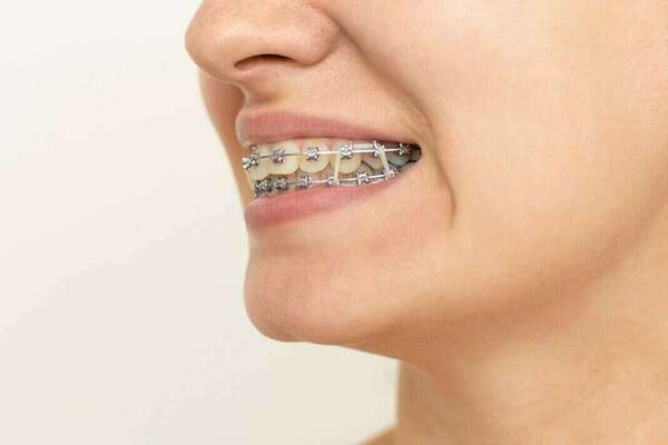 Les élastiques en orthodontie