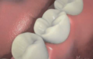 Pose d'implants et couronnes